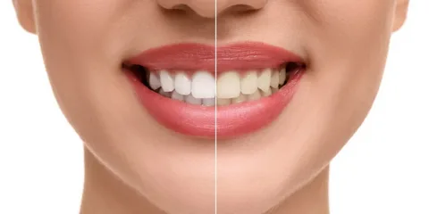 teeth whitening Barangaroo